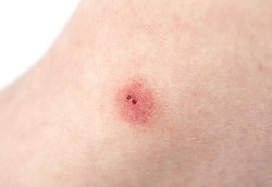 Obati Gigitan Serangga Cukup dengan Kain Basah