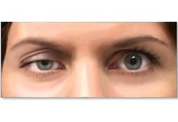 Kelopak Mata Tiba-tiba Jatuh, Waspada Penyakit Langka Miastenia Gravis