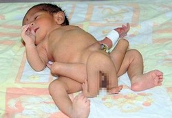 Kembar Gagal, Kaki dan Tangan Nemplok di Kaki Bayi yang Hidup
