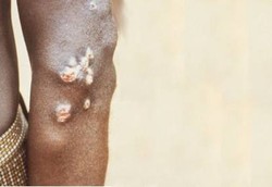  Penyakit Jadul Frambusia Tak Pernah Lenyap di Halmahera Selatan 