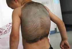 Cangkang Kura-kura Berhasil Lepas dari Punggung Bocah Ini