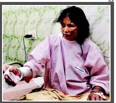 Dituduh Selingkuh, Istri Disiram Air Keras oleh Suami