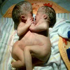  Bayi Kembar Siam Lahir di Bali
