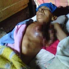 Payudara Narti Pecah Akibat Kanker yang Diderita