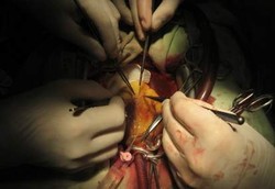 Untung Rugi Cangkok Lemak Dibanding Implan Payudara