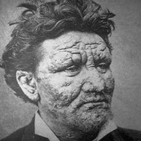 Aksi Amal Komunitas Indonesia-Walikota se-Belanda Demi Penderita Lepra