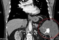 Dokter Pakai Semen untuk Tambal Dada Pasien Pasca Operasi