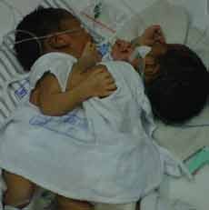 Ibu Bayi Kembar Siam Dempet Dada Belum Tahu Kondisi Anaknya