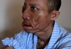 Tumor Sebesar Bola Sepak Berhasil Diangkat dari Pria Ini