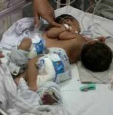Gagal Jantung, Bayi Kembar Siam Dempet Dada Perut Meninggal