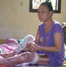 Purwaningsih, Satu Korban Lumpur Lapindo Cacat Seumur Hidup