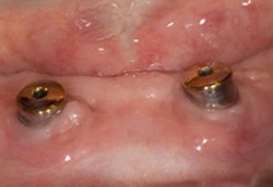 Gigi Palsu Magnet Mulai Digemari Orang Indonesia