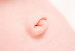 Hernia Umbilikalis, Pusar yang Menonjol pada Bayi