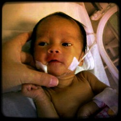 Bayi Raline Penderita Kelainan Pencernaan Meninggal Dunia