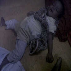 Halimah, Balita Penderita Gizi Buruk di Penjaringan Dirawat di RSCM 