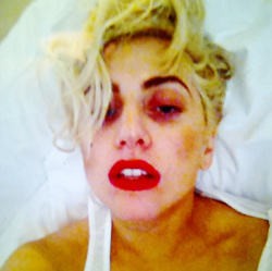 Ini Dia Wajah Lady Gaga Usai Insiden di Atas Panggung