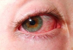 Trachoma, Infeksi Mata Akibat Bakteri Chlamydia Trachomatis