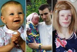 Karena Sebatang Rokok sang Ibu, Wajah si Gadis Hancur Menakutkan 