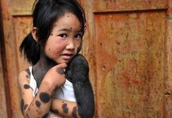 Gadis Cilik Berwajah Putih Tapi Bahu dan Badan Hitam Penuh Bulu