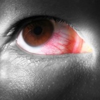 Lakukan Ini Saat Mata Alergi