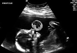 Pertama di Dunia, Dokter Berhasil Angkat Tumor Janin dalam Rahim