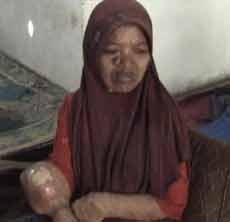 Sekujur Kulit Maslikah Dipenuhi Gelembung Hingga Terasa Panas