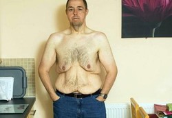 Berat Badan Sudah Turun 102 Kg Tapi Masih Tak Pede Karena Kulit Gelambir