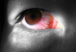 Distrofi fuchs, Kelebihan Cairan pada Kornea Mata