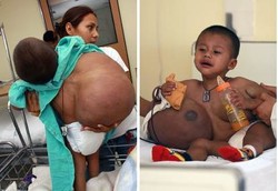 Balita Mengenaskan: Tumornya 15 Kg, Berat Badannya 12 Kg
