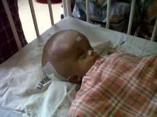 Tolong! Bayi Penderita Hydrocephalus Butuh Bantuan