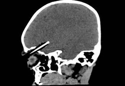 Pensil Masuk Rongga Bola Mata, si Balita Nyaris Meninggal