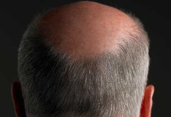 Penggunaan Obat Rambut Rontok Pengaruhi Gairah Seksual Pria