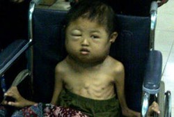 Ferdi, Bocah Penderita Kanker Kelanjar Getah Bening Meninggal