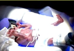 Bayi yang Lebih Kecil dari Kaleng Soda Itu Akhirnya Bisa Bertahan Hidup