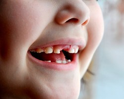 Ketika Gigi Si Kecil Mulai Goyang & Tanggal