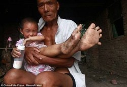 Bocah Berbadan Mungil yang Punya Telapak Kaki Selebar Raksasa