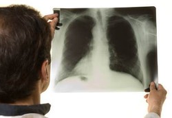 COPD, Penyakit Kronis Paru-paru Karena Kebiasaan Merokok
