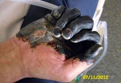 Jari Tangan dan Kaki Hitam Membusuk Karena Gigitan Kucing