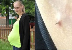 Ngeri! Jarum Bedah Menyembul dari Perut Ibu Hamil