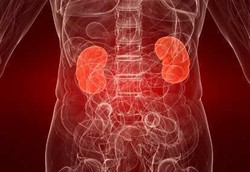 Suka Makanan Asin? Hati-hati Risiko Batu Ginjal dan Osteoporosis