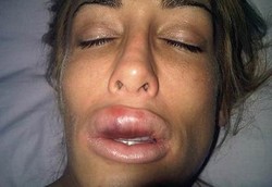 Bibir Jadi Jontor Karena Kecanduan Operasi Plastik