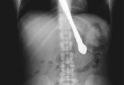 Wanita Bulimia Tak Sengaja Telan Pisau Karena Ingin Pamer