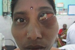 2 Buah Gigi Tumbuh di Dalam Mata Selama 23 Tahun