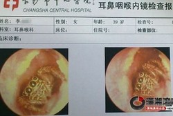 Gatal-gatal Sampai 5 Hari Ternyata Ada Laba-laba di Telinga