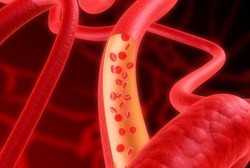 Fistula Arteriovenosa, Kondisi Abnormal Antara Arteri dan Vena