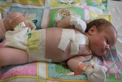 Bayi dengan Jantung Mini Jadi Pasien Operasi Termuda