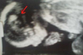 Penampakan-penampakan Aneh dalam Foto USG