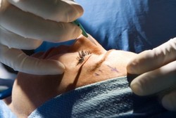 Ini Akibat Salah Operasi Plastik