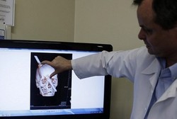 Tetap Bugar Setelah Kepala Tertembus Besi Sepanjang 2 Meter