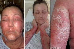 Kulit Tubuh Mengelupas Seperti Ular Karena Efek Samping Obat